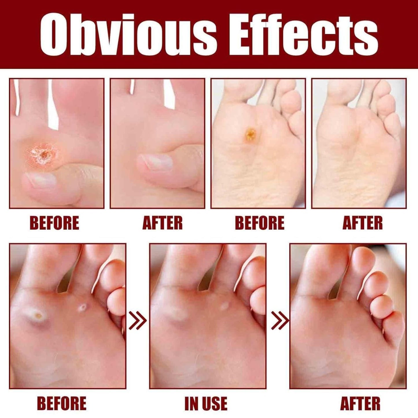 Feet Corn Removal Serum 30ml ( Pack Of 1 ) - OwnzoKart